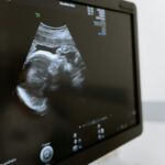 Should I Get an Early Pregnancy Scan? The MotherScan Guide